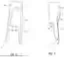Fig. 05 - Method of forming and decorticating a void in a sacroiliac joint