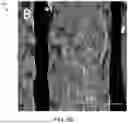 Fig. 11 - MONOLAYER CELL PATCH IN AN EXTRACELLULAR MATRIX SCAFFOLD