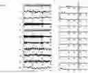 Fig. 06 - APPARATUS AND METHOD OF NONINVASIVELY AND SEPARATELY MEASURING LUNG VENTILATION AND CARDIAC BLOOD FLOW COMPONENTS