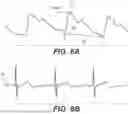 Fig. 06 - Devices and methods for determining blood flow around a body lumen