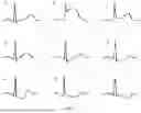 Fig. 02 - METHOD AND APPARATUS FOR DETERMINING CORONARY HEART DISEASE PROBABILITY
