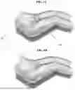 Fig. 06 - PREOPERATIVE METHOD AND SYSTEM FOR MINIMIZING WOUND COMPLICATIONS