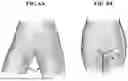 Fig. 07 - PREOPERATIVE METHOD AND SYSTEM FOR MINIMIZING WOUND COMPLICATIONS