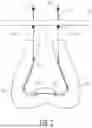 Fig. 03 - Filamentary Fixation Device