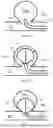 Fig. 06 - LONGITUDINALLY COMPRESSIBLE VASCULAR OCCLUDER
