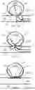 Fig. 07 - LONGITUDINALLY COMPRESSIBLE VASCULAR OCCLUDER