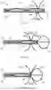 Fig. 08 - LONGITUDINALLY COMPRESSIBLE VASCULAR OCCLUDER