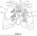 Fig. 02 - NON-INVASIVE AND MINIMALLY INVASIVE DENERVATION METHODS AND SYSTEMS FOR PERFORMING THE SAME