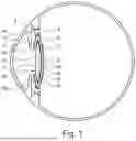 Fig. 02 - APPARATUS AND METHOD FOR LENS SURGERY