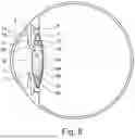 Fig. 09 - APPARATUS AND METHOD FOR LENS SURGERY