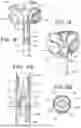Fig. 04 - BRAIDED IMPLANT WITH DETACHMENT MECHANISM