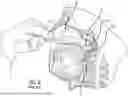Fig. 07 - EUSTACHIAN TUBE DILATION BALLOON WITH VENTILATION PATH
