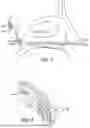 Fig. 08 - EUSTACHIAN TUBE DILATION BALLOON WITH VENTILATION PATH