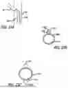 Fig. 35 - EUSTACHIAN TUBE DILATION BALLOON WITH VENTILATION PATH