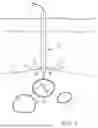 Fig. 02 - TISSUE CLOSURE DEVICE