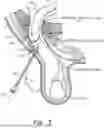 Fig. 04 - METHOD AND PROSTHESIS FOR PERCUTANEOUS HERNIA REPAIR