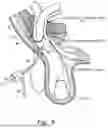 Fig. 06 - METHOD AND PROSTHESIS FOR PERCUTANEOUS HERNIA REPAIR