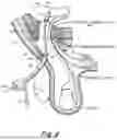 Fig. 07 - METHOD AND PROSTHESIS FOR PERCUTANEOUS HERNIA REPAIR
