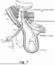 Fig. 08 - METHOD AND PROSTHESIS FOR PERCUTANEOUS HERNIA REPAIR