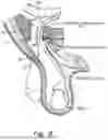 Fig. 09 - METHOD AND PROSTHESIS FOR PERCUTANEOUS HERNIA REPAIR