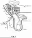 Fig. 11 - METHOD AND PROSTHESIS FOR PERCUTANEOUS HERNIA REPAIR