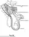 Fig. 12 - METHOD AND PROSTHESIS FOR PERCUTANEOUS HERNIA REPAIR