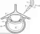 Fig. 01 - IN-SITU ADDITIVE CHANNELED IMPLANTS