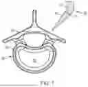 Fig. 02 - IN-SITU ADDITIVE CHANNELED IMPLANTS