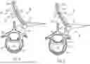 Fig. 04 - IN-SITU ADDITIVE CHANNELED IMPLANTS