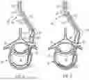 Fig. 06 - IN-SITU ADDITIVE CHANNELED IMPLANTS