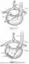 Fig. 09 - IN-SITU ADDITIVE CHANNELED IMPLANTS
