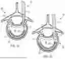 Fig. 12 - IN-SITU ADDITIVE CHANNELED IMPLANTS