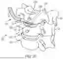 Fig. 16 - IN-SITU ADDITIVE CHANNELED IMPLANTS