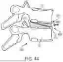 Fig. 32 - IN-SITU ADDITIVE CHANNELED IMPLANTS