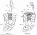 Fig. 45 - IN-SITU ADDITIVE CHANNELED IMPLANTS