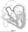 Fig. 02 - CATHETER-GUIDED REPLACEMENT VALVES APPARATUS AND METHODS