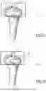 Fig. 08 - SURGICAL INSTRUMENT TO IMPLANT PRIMARY AND SECONDARY ELEMENTS