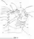 Fig. 06 - IMPLANT STEM WITH SUTURE RETENTION STRUCTURE