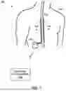 Fig. 02 - PARAMETER SELECTION FOR ELECTRICAL STIMULATION THERAPY
