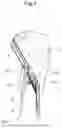 Fig. 02 - SURGICAL INSTRUMENT SUITABLE FOR PROTECTING TISSUE DURING BONE SURGERY, FOR EXAMPLE WHEN CUTTING OR DRILLING A BONE