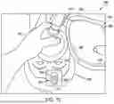Fig. 23 - Augmented Reality Device for Providing Feedback to an Acute Care Provider