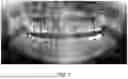 Fig. 02 - THERAPEUTIC TOOTH BUD ABLATION
