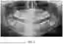 Fig. 03 - THERAPEUTIC TOOTH BUD ABLATION