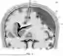 Fig. 02 - Systems, devices, and methods for accessing a subdural space