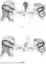 Fig. 02 - DEVICE FOR SPEECH THERAPY, ADMINISTRATION OF INHALATION MEDICATION AND FOR TREATMENT OF OTITIS, SINUSITIS AND BAROTRAUMA