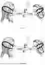 Fig. 03 - DEVICE FOR SPEECH THERAPY, ADMINISTRATION OF INHALATION MEDICATION AND FOR TREATMENT OF OTITIS, SINUSITIS AND BAROTRAUMA