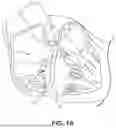 Fig. 02 - IMPLANTABLE MEDICAL ELECTRODE ASSEMBLIES, DEVICES, SYSTEMS, KITS, AND METHODS