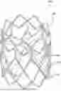 Fig. 01 - METHODS FOR IMPROVED PROSTHETIC HEART VALVE WITH LEAFLET SHELVING