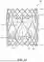 Fig. 02 - METHODS FOR IMPROVED PROSTHETIC HEART VALVE WITH LEAFLET SHELVING