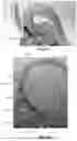 Fig. 33 - CATHETER SYSTEM FOR SEQUENTIAL DEPLOYMENT OF AN EXPANDABLE IMPLANT